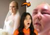 Botched Microneedling Horror Shocks Brides