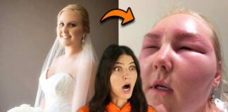 Botched Microneedling Horror Shocks Brides